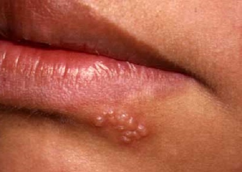 Cold Sores - WebMD