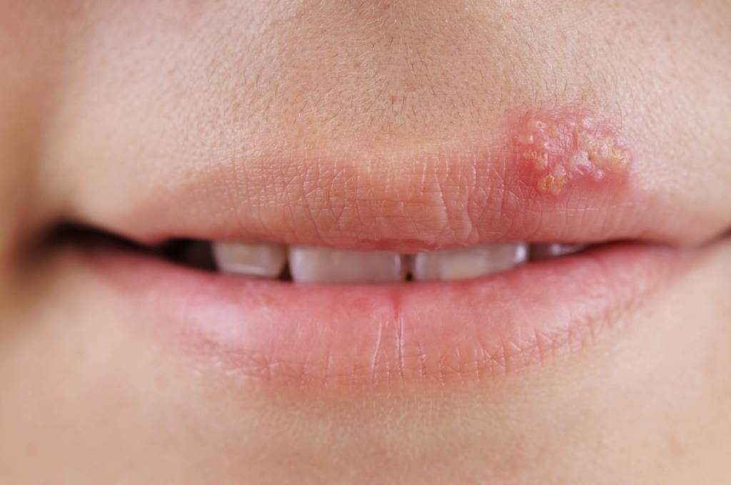 infección herpes simple