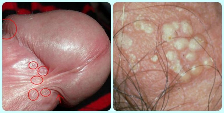 el herpes en el pene se reproduce en varios sitios