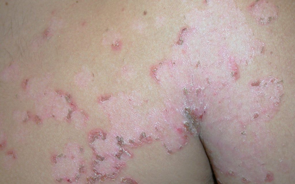 Cuidados al sufrir un herpes zoster