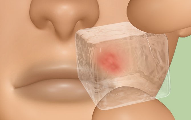5 tips para cobatir el herpes labial