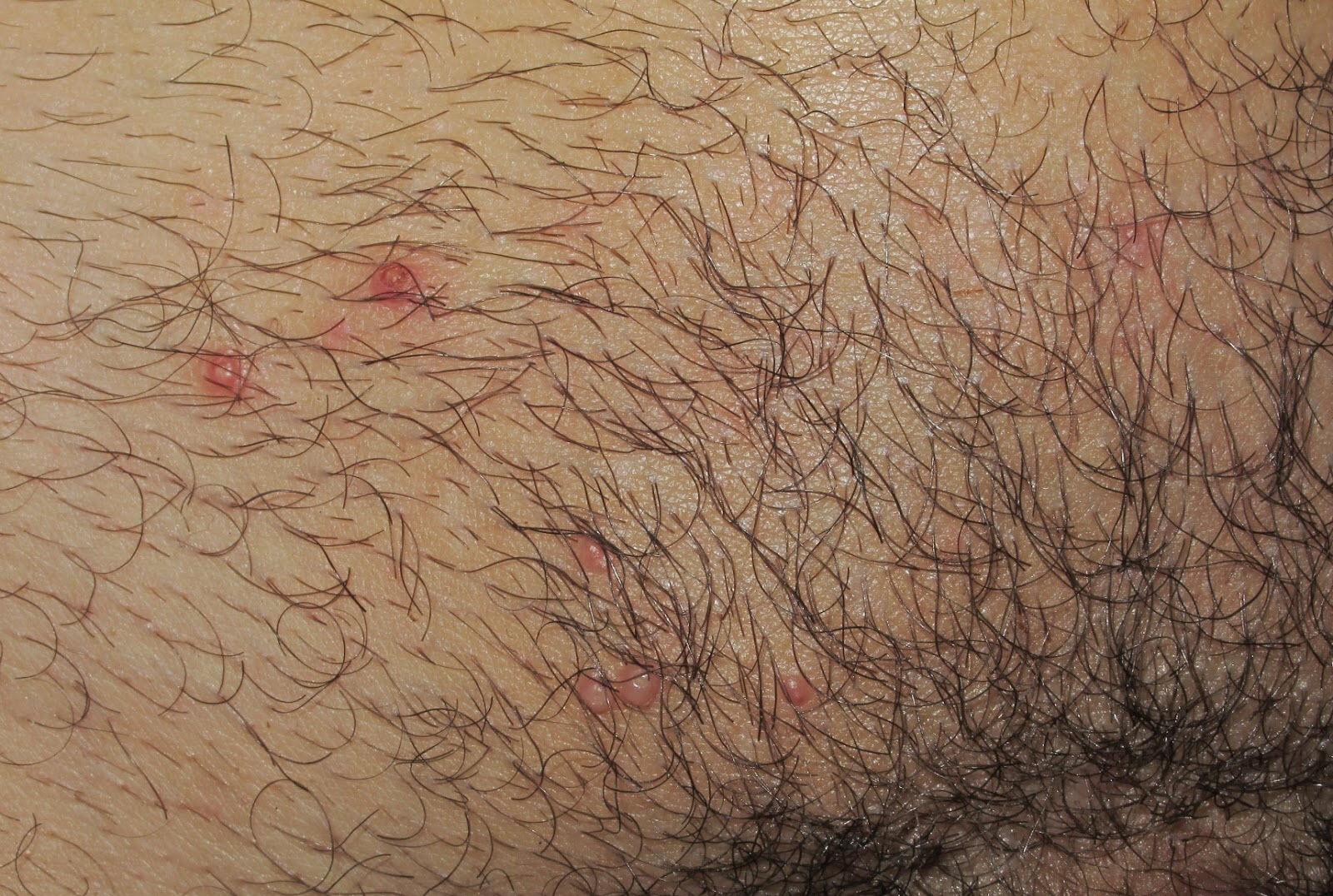 como identificar el herpes genital en los testiculos