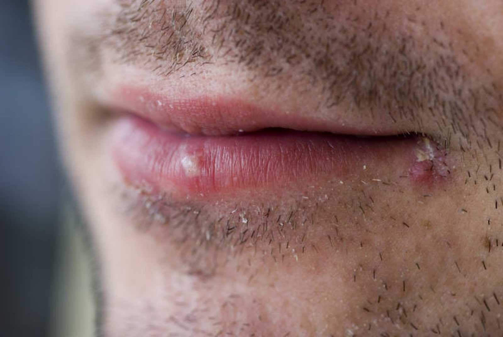 herpes simple con barba puede infactarse mucho más