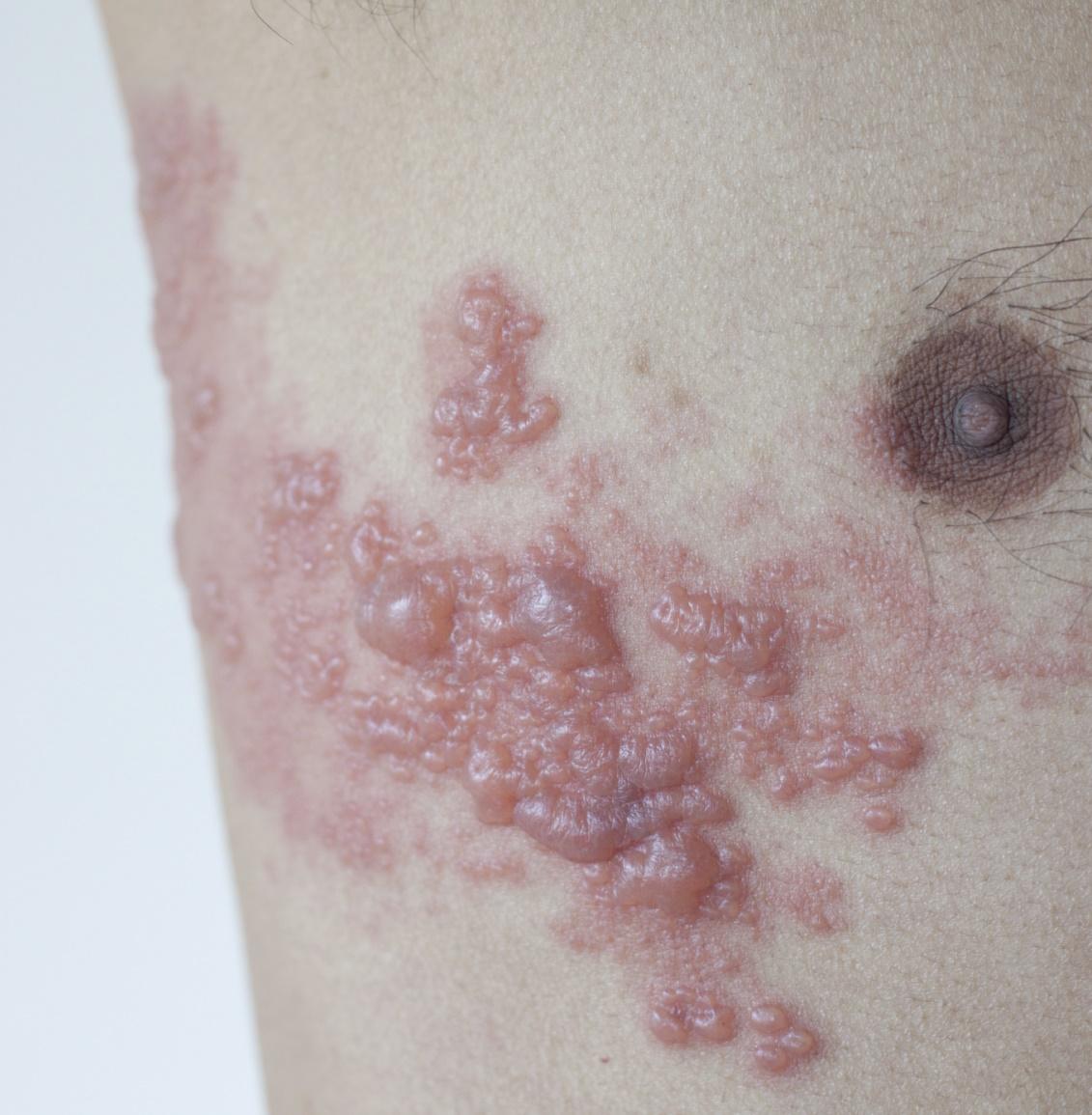 Sintomas herpes zoster