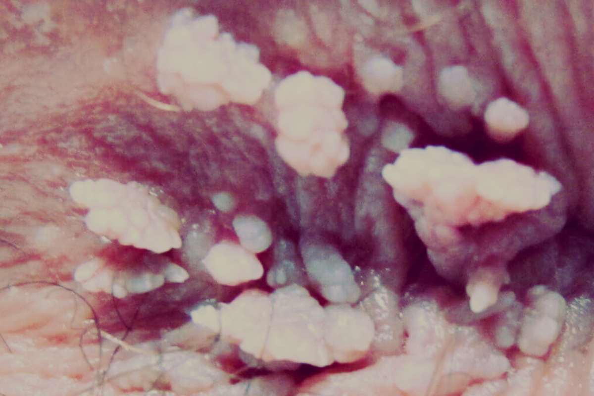 imagen herpes femenino en las partes intimas