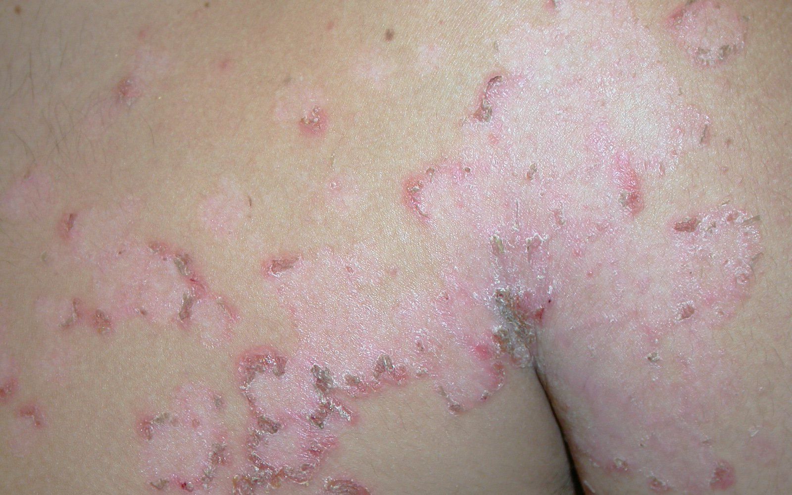 Cuidados al sufrir un herpes zoster